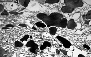 F,53y. | ochronosis … black aortal valve F,53y. | ochronosis … black aortal valve